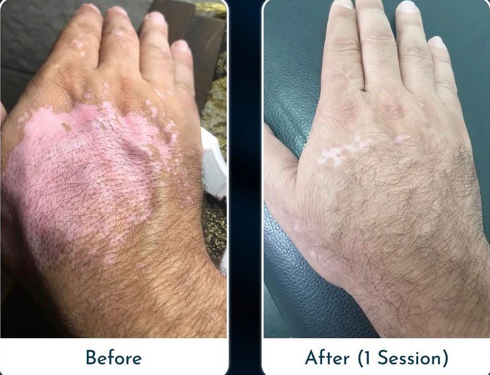 ASCE Hand Before After